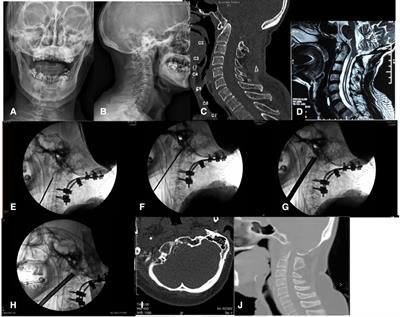 Full-endoscopic uniportal retropharyngeal odontoidectomy: A preliminary case report